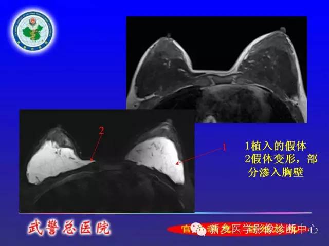 【PPT】MRI对乳腺疾病的诊断