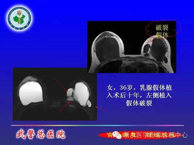 【PPT】MRI对乳腺疾病的诊断