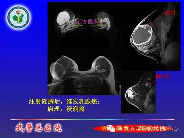 【PPT】MRI对乳腺疾病的诊断