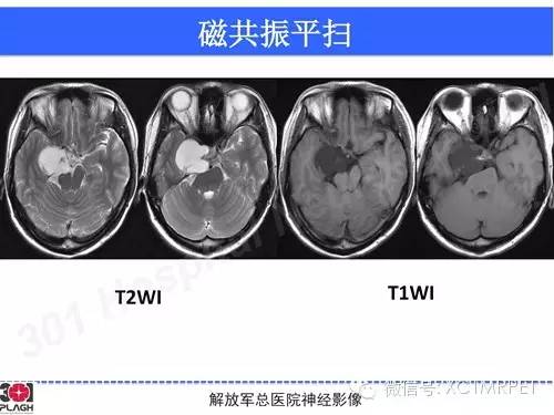 【病例】鞍旁软骨肉瘤1例CT及MR影像表现