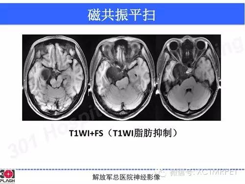 【病例】鞍旁软骨肉瘤1例CT及MR影像表现