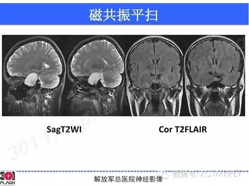 【病例】鞍旁软骨肉瘤1例CT及MR影像表现