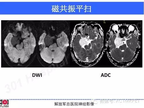 【病例】鞍旁软骨肉瘤1例CT及MR影像表现