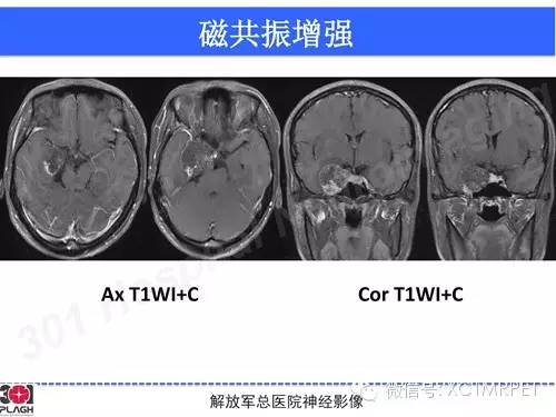 【病例】鞍旁软骨肉瘤1例CT及MR影像表现