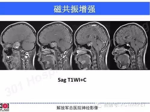 【病例】鞍旁软骨肉瘤1例CT及MR影像表现