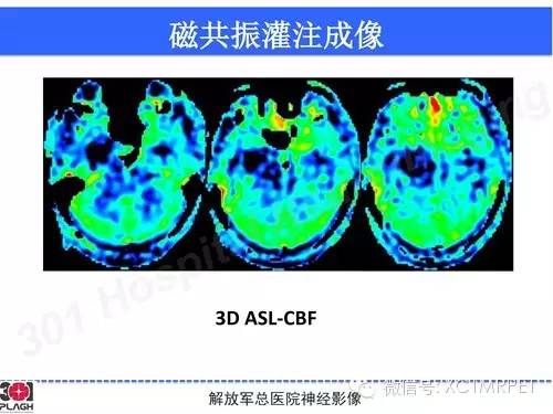 【病例】鞍旁软骨肉瘤1例CT及MR影像表现