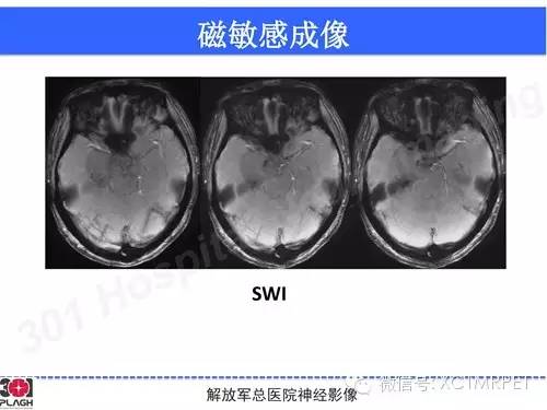 【病例】鞍旁软骨肉瘤1例CT及MR影像表现