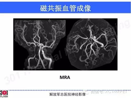 【病例】鞍旁软骨肉瘤1例CT及MR影像表现