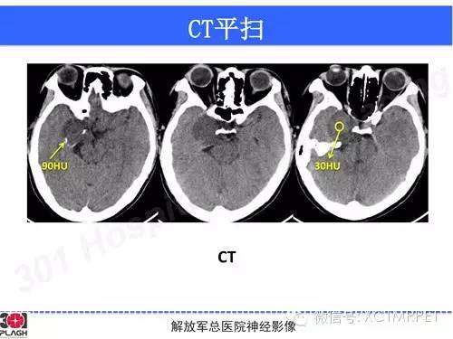 【病例】鞍旁软骨肉瘤1例CT及MR影像表现