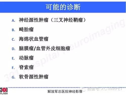 【病例】鞍旁软骨肉瘤1例CT及MR影像表现