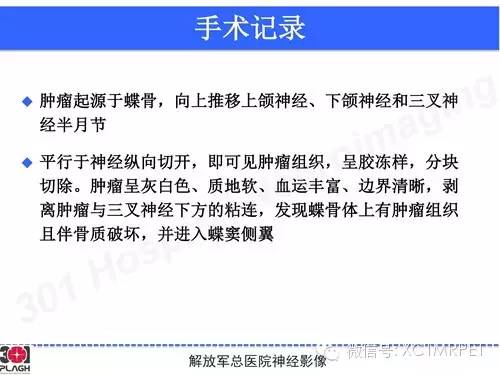【病例】鞍旁软骨肉瘤1例CT及MR影像表现