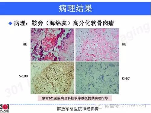【病例】鞍旁软骨肉瘤1例CT及MR影像表现