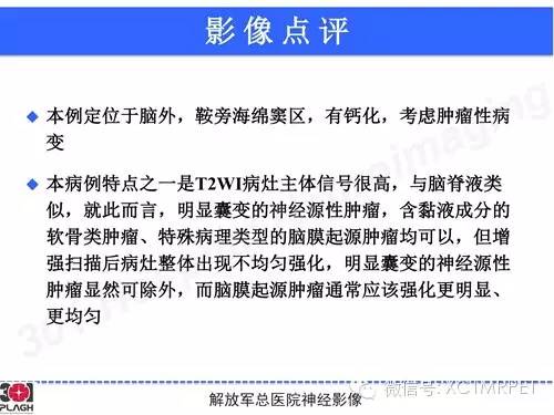 【病例】鞍旁软骨肉瘤1例CT及MR影像表现