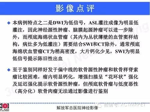 【病例】鞍旁软骨肉瘤1例CT及MR影像表现