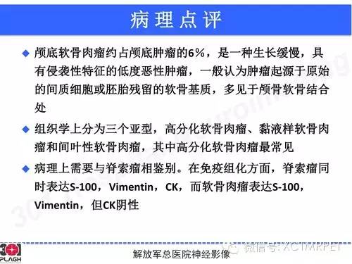 【病例】鞍旁软骨肉瘤1例CT及MR影像表现