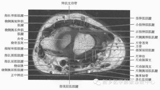 腕关节MR断层解剖+详细标注
