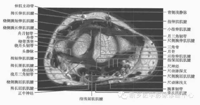 腕关节MR断层解剖+详细标注