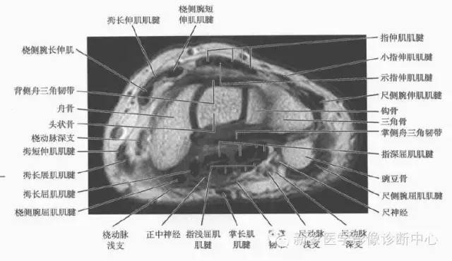 腕关节MR断层解剖+详细标注