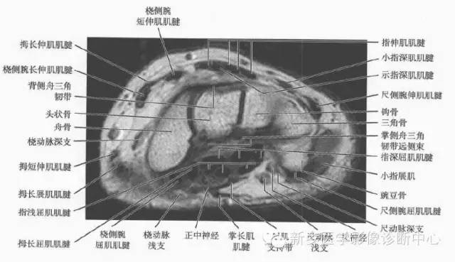腕关节MR断层解剖+详细标注