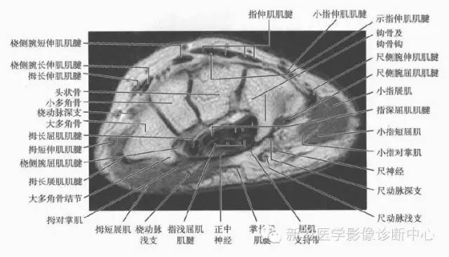 腕关节MR断层解剖+详细标注