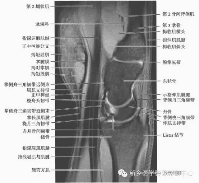 腕关节MR断层解剖+详细标注