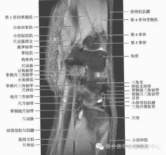 腕关节MR断层解剖+详细标注