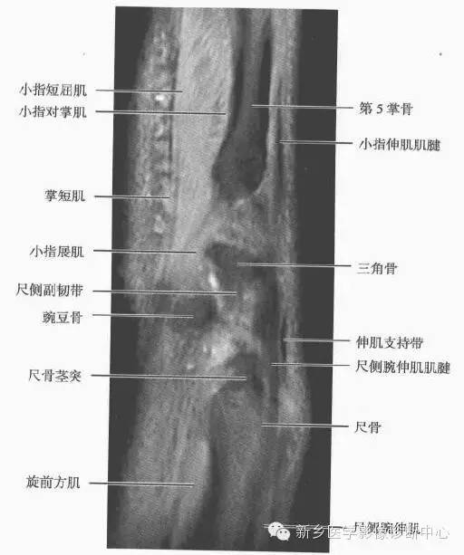 腕关节MR断层解剖+详细标注