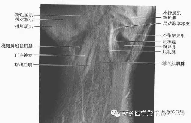 腕关节MR断层解剖+详细标注