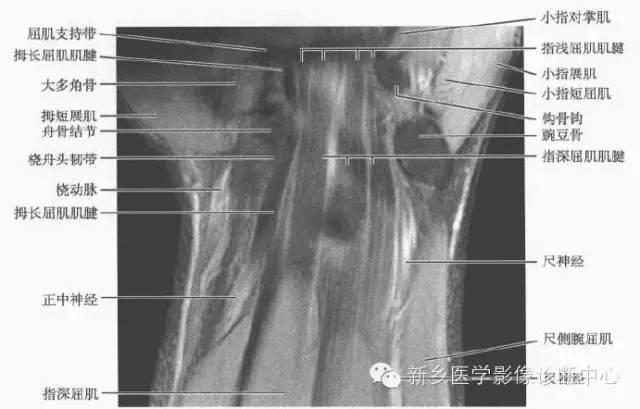 腕关节MR断层解剖+详细标注