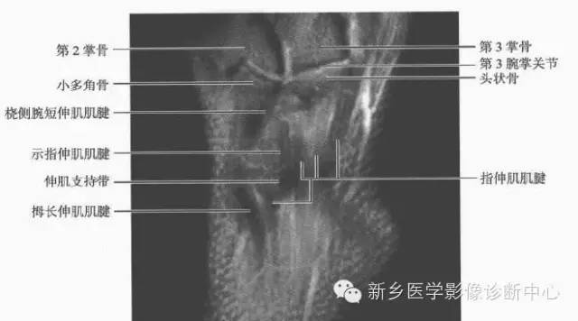 腕关节MR断层解剖+详细标注