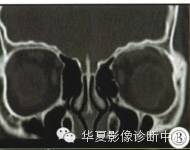 【病例】眶内绿色瘤误诊1例影像表现