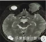 【病例】眶内绿色瘤误诊1例影像表现