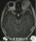 【病例】眶内绿色瘤误诊1例影像表现