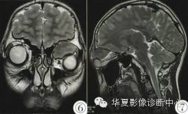 【病例】眶内绿色瘤误诊1例影像表现