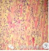【病例】眶内绿色瘤误诊1例影像表现