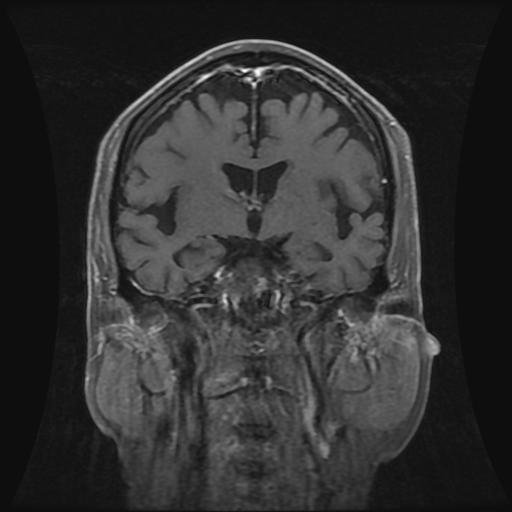 【病例】表皮样囊肿1例MR影像表现 【病例】表皮样囊肿1例MR影像表现