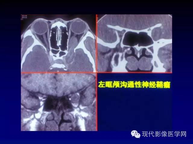 【PPT】眼眶肿瘤的CT MRI诊断