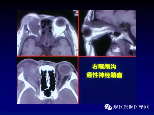 【PPT】眼眶肿瘤的CT MRI诊断