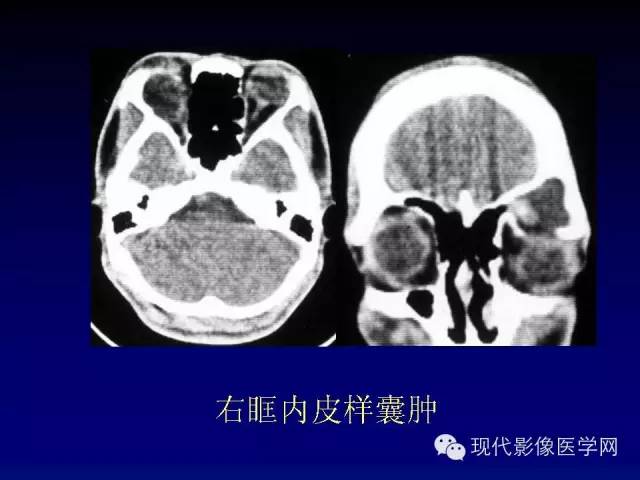 【PPT】眼眶肿瘤的CT MRI诊断
