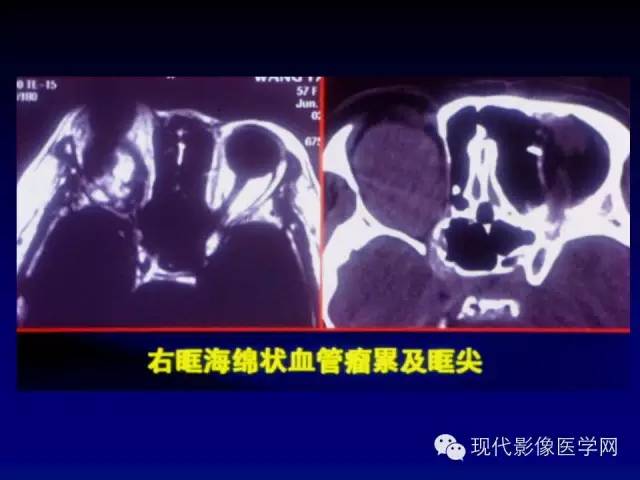 【PPT】眼眶肿瘤的CT MRI诊断