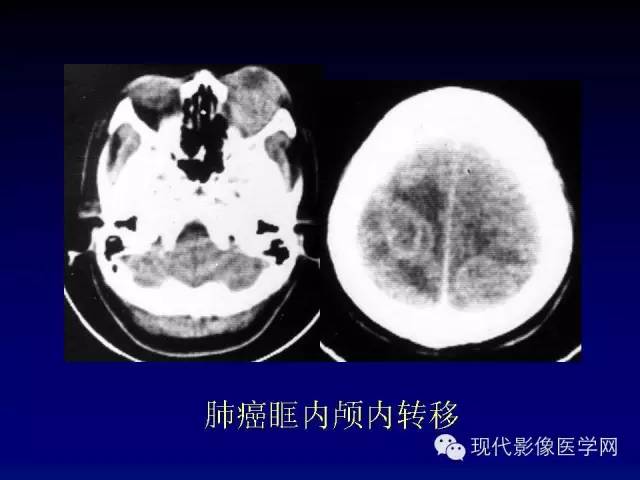【PPT】眼眶肿瘤的CT MRI诊断