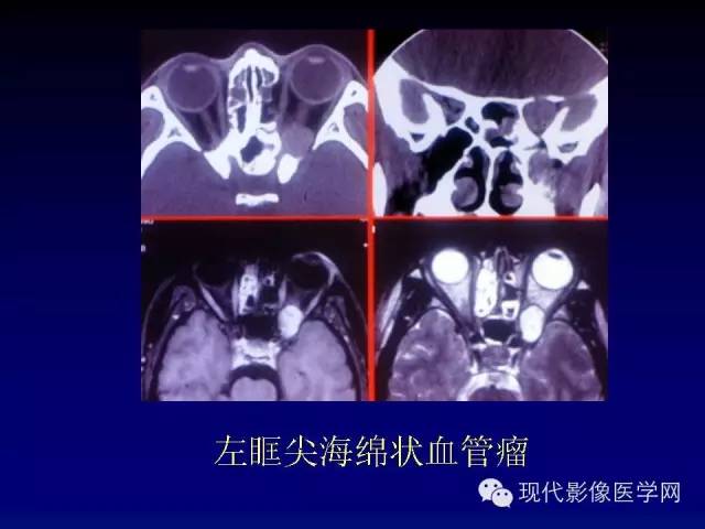 【PPT】眼眶肿瘤的CT MRI诊断