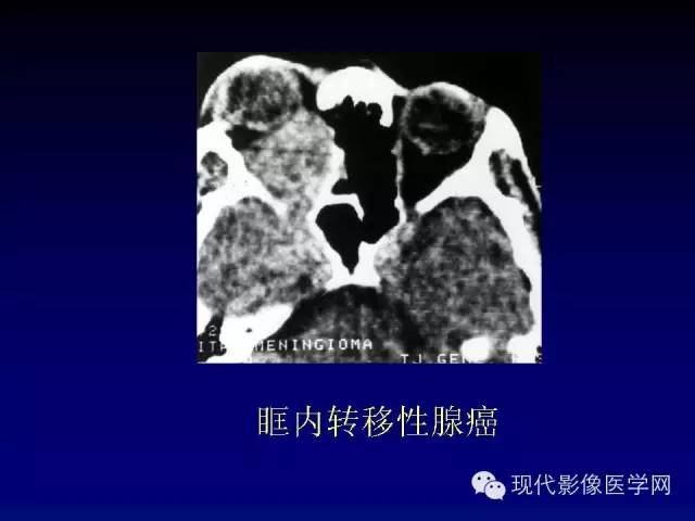 【PPT】眼眶肿瘤的CT MRI诊断