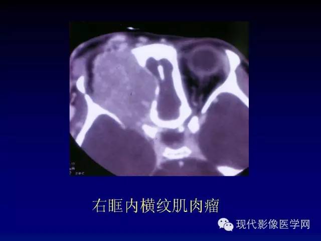 【PPT】眼眶肿瘤的CT MRI诊断