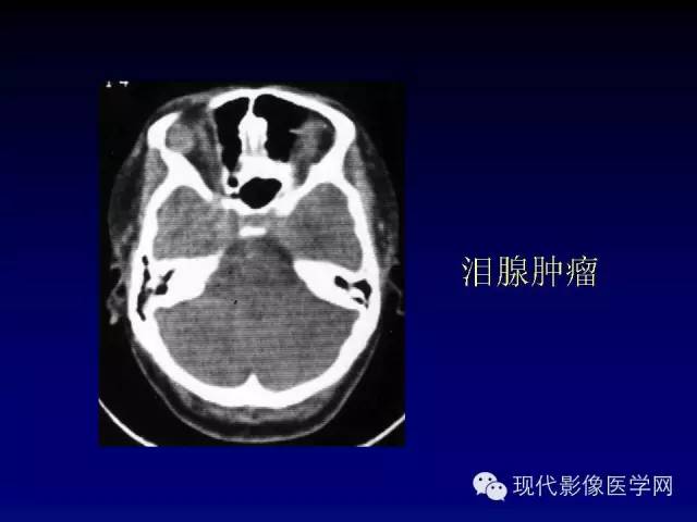 【PPT】眼眶肿瘤的CT MRI诊断