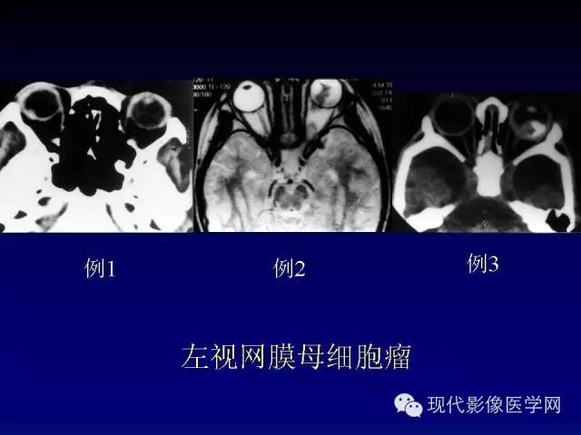 【PPT】眼眶肿瘤的CT MRI诊断