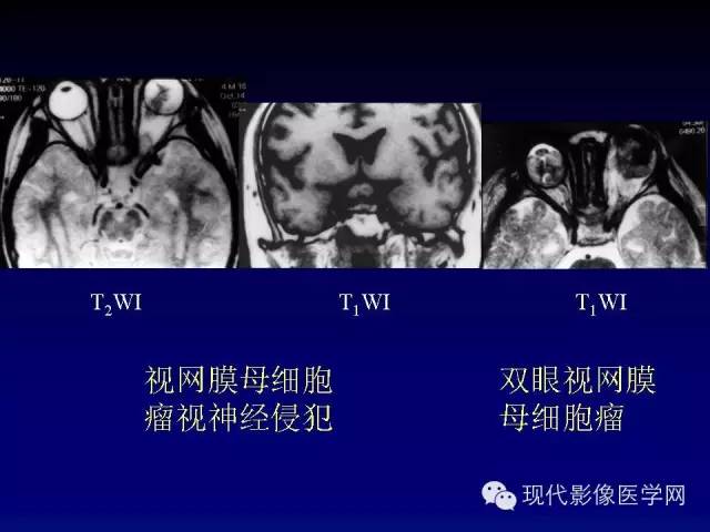 【PPT】眼眶肿瘤的CT MRI诊断