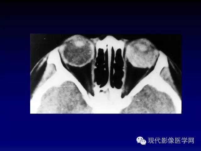 【PPT】眼眶肿瘤的CT MRI诊断