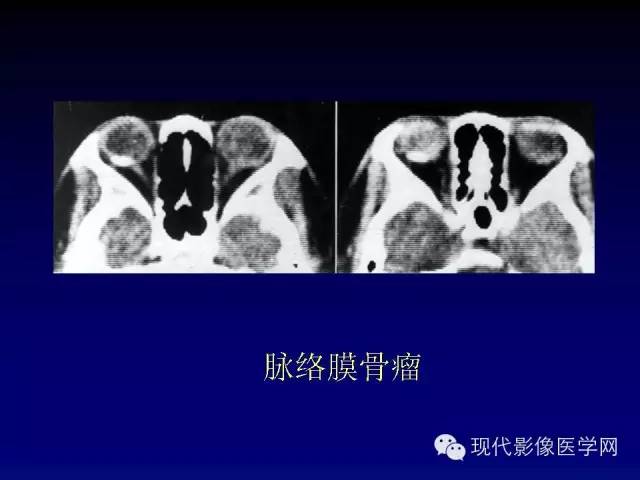 【PPT】眼眶肿瘤的CT MRI诊断