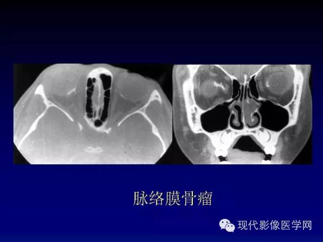 【PPT】眼眶肿瘤的CT MRI诊断